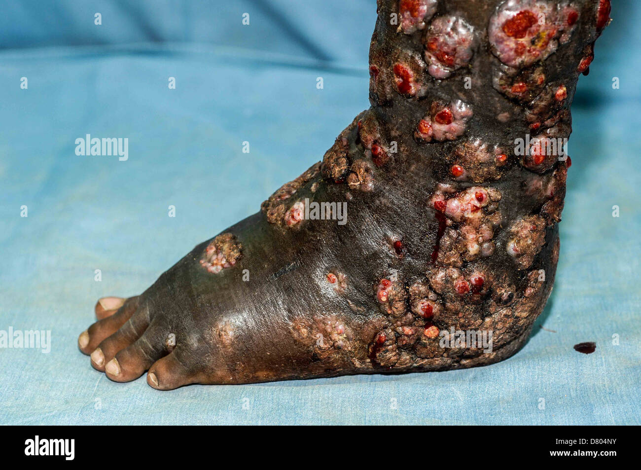 Leg of a 37 year old male suffering from severe mycetoma in his left foot and lower leg. Stock Photo