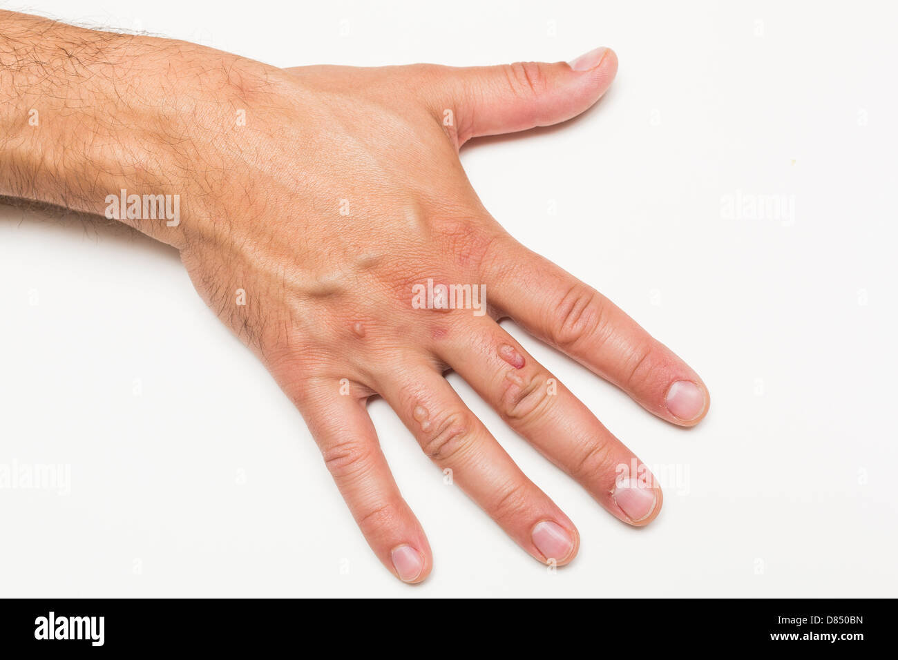 Man's hand covered with blisters caused by cryosurgery wart removal