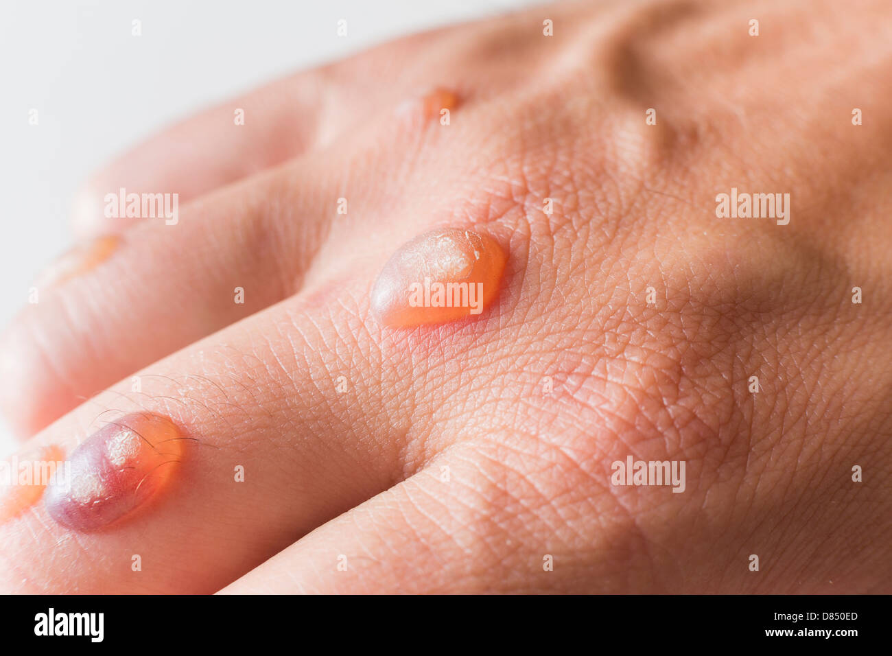 Plantar wart High Resolution Stock Photography and Images Alamy