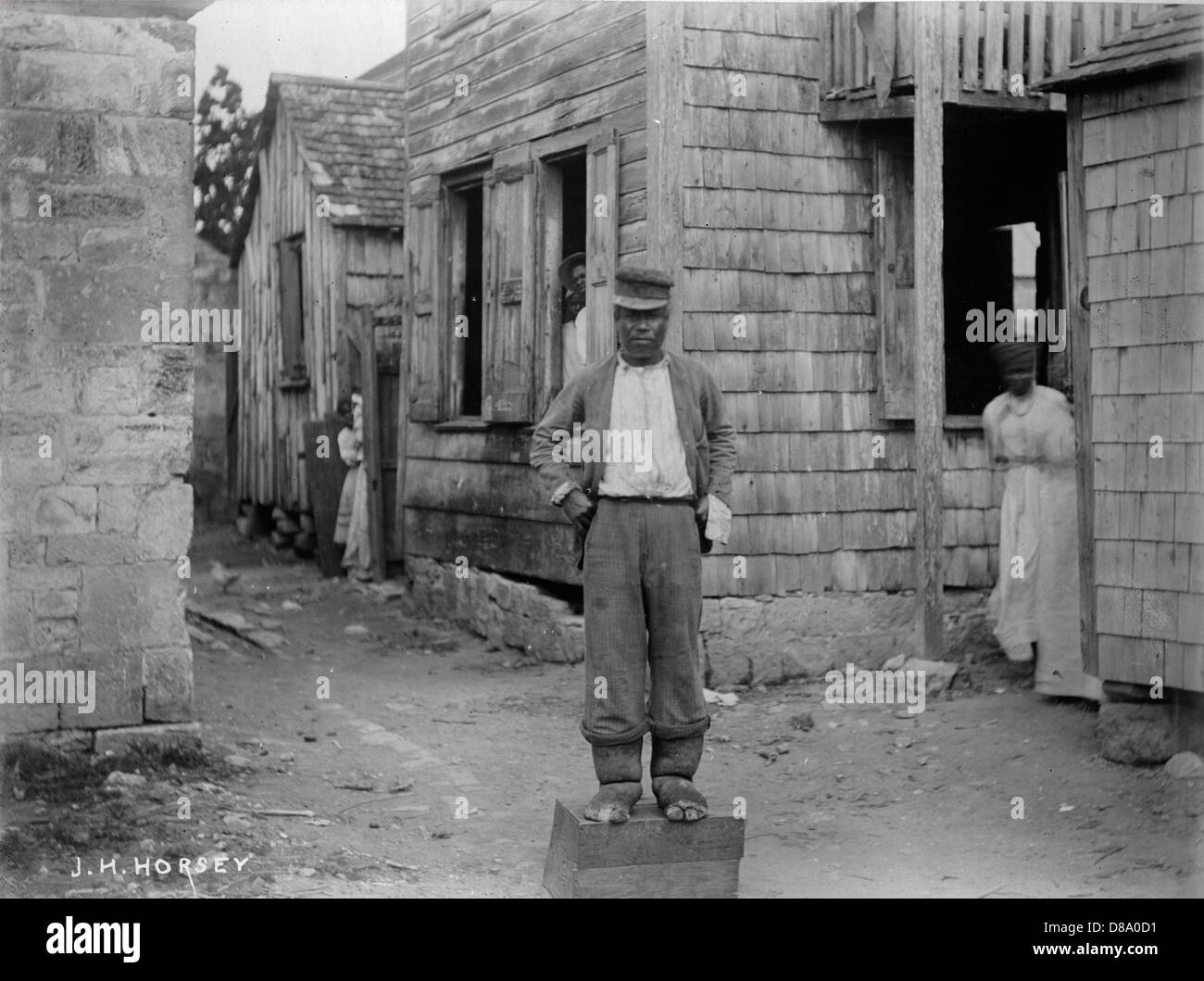 Elephantiasis Victim, Antigua, ca 1890, by J.H. Horsey Stock Photo