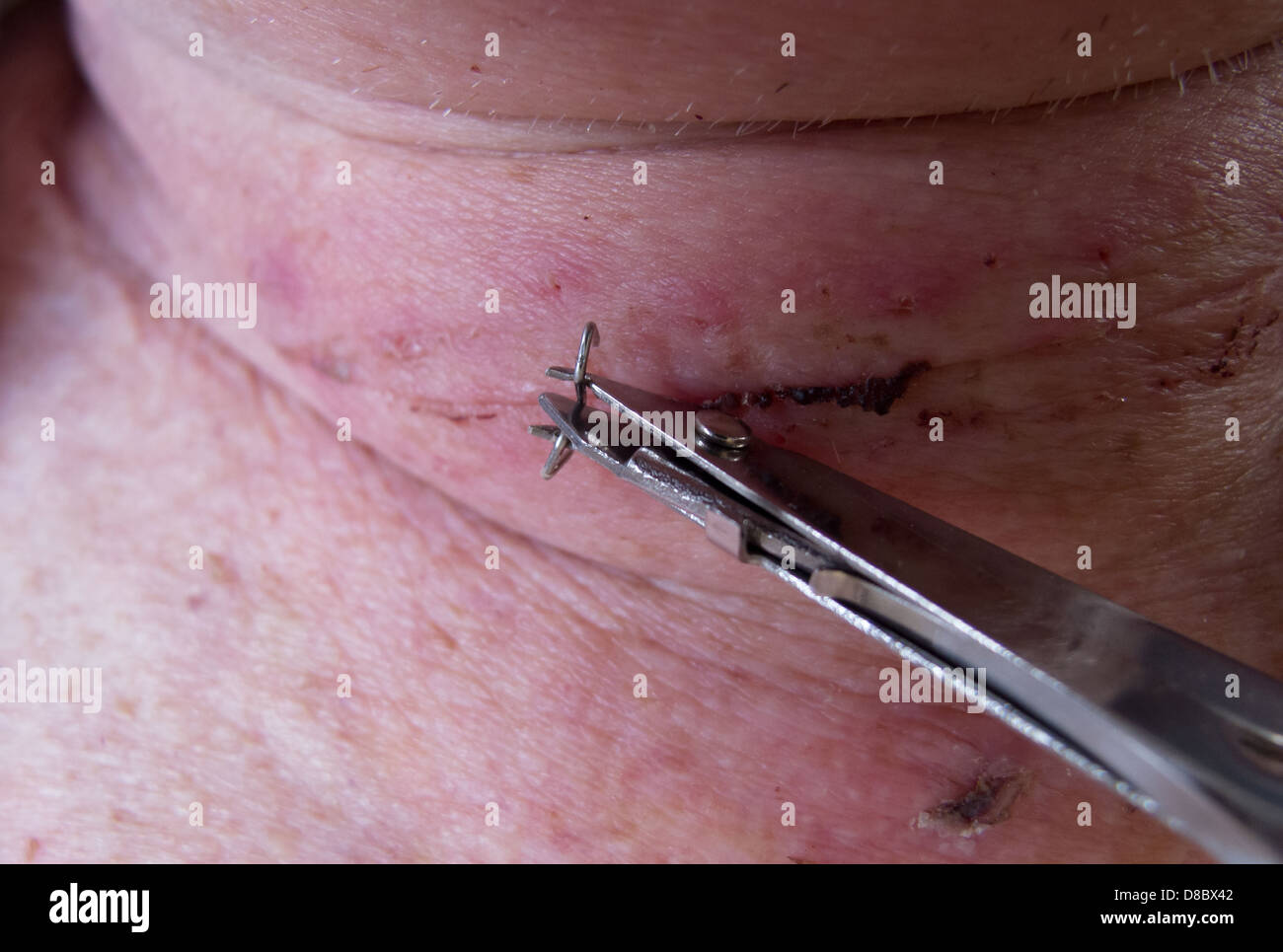 Medical instrument being used to remove surgical clip from  post-thyroidectomy incision.Shows how the instrument grips the clip Stock  Photo - Alamy