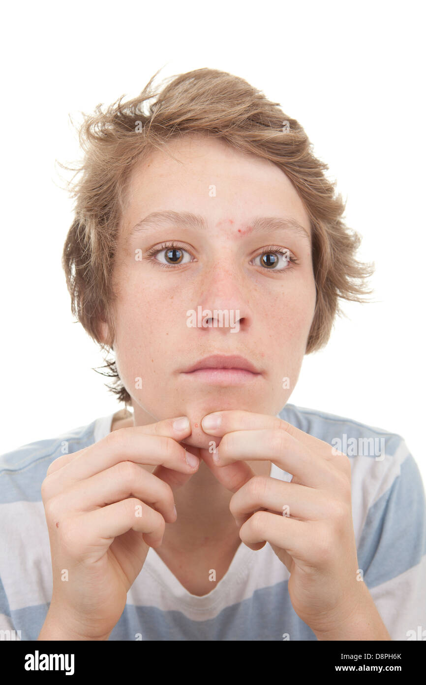 kid with puberty acne spots Stock Photo