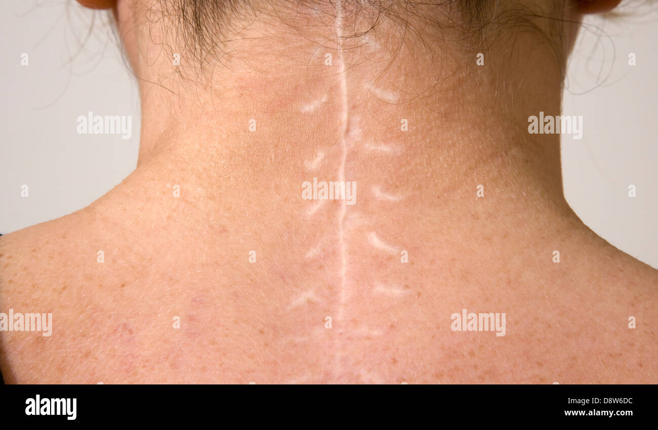 Surgical scar ( with stitches ) on the back of a persons neck after successful surgery on the spine. (66) Stock Photo