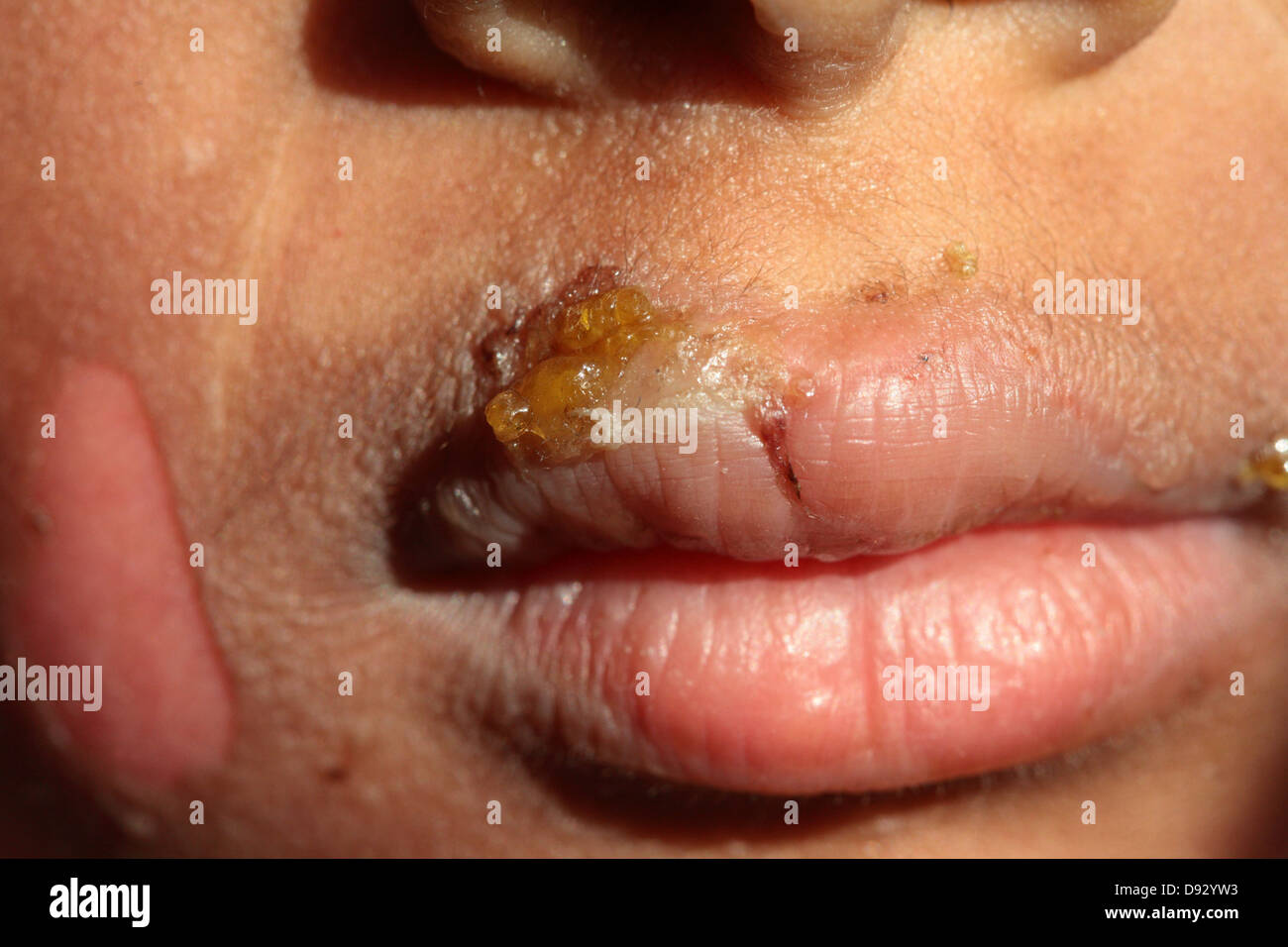 First and mild second degree facial liquid burn injury in a child caused by hot milk boiling over Stock Photo