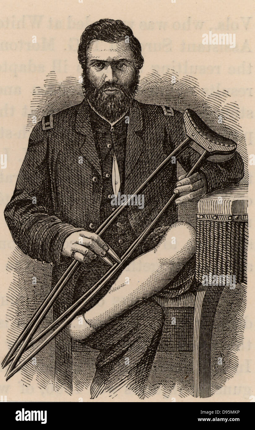 American Civil War 1861-1865.  Casualty displaying the healed stump after removal of his foot by Pirogof amputation.  Wood engraving 1865. Stock Photo