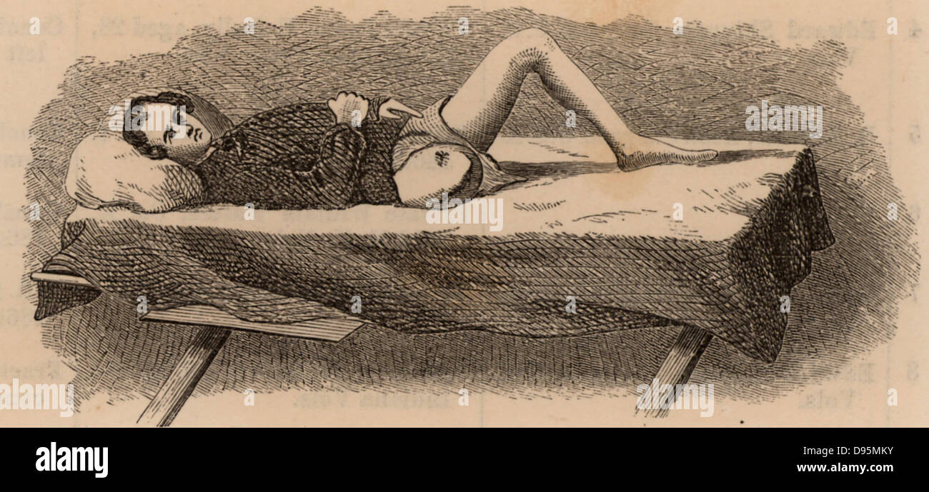American Civil War 1861-1865.  Casualty displaying healed stump after removal of his leg at the hip joint. Wood engraving 1865. Stock Photo