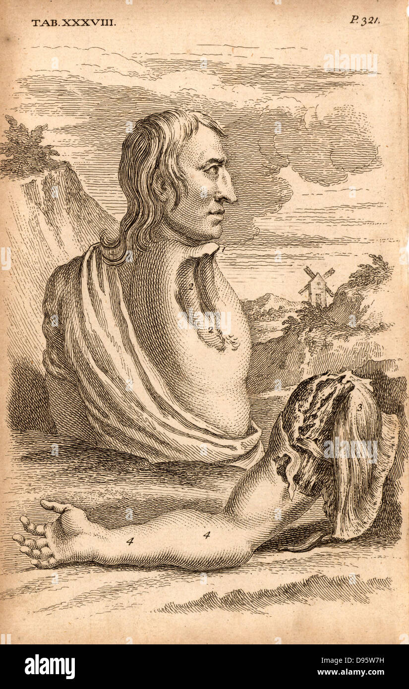 The miller Samuel Wood, whose arm and scapula were torn off when entangled in a rope attached to the moving mill machinery (1737). There was very little bleeding, and the amount of skin left was enough to cover the wound.  A superficial dressing was applied and healing took place without complications. The author advises always leaving a similar area of skin when performng an amputation.  From 'The Anatomy of the Human Body' by William Cheselden (London, c1745). First edition published 1713. Engraving. Stock Photo