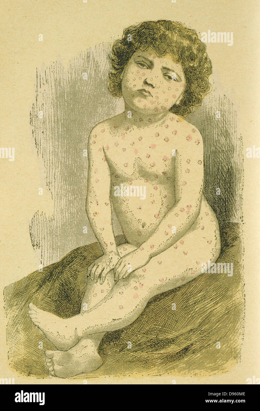 Child suffering from Measles  (Rubeola Morbilli), a widespread viral infection spread by air-borne droplets.  A routine vaccine was not available until 1964.  From Jules Rengade 'Les Grands Maux et les Grands Remedes', Paris, c1890. Stock Photo
