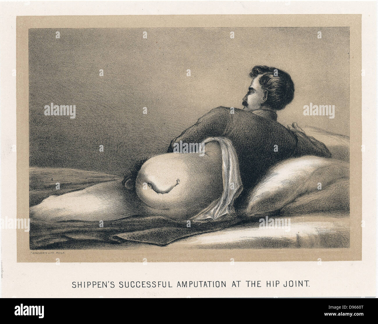 Successful amputation at the hip joint on casualty in American Civil War. Mortality from this procedure was in excess of  70%. Shippen's amputation. From 'Circular No.6', Surgeon General's Office, Washington, 1 November, 1865. Tinted lithograph. Stock Photo