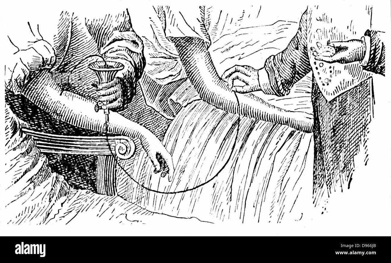 Blood Transfusion: blood flowed from arm of donor, left, into cup, and was then pumped from the bottom of cup and forced through canula into patient. Before use, apparatus immersed in tepid water to prevent coagulation. Engraving from technical dictionary c1880. Stock Photo