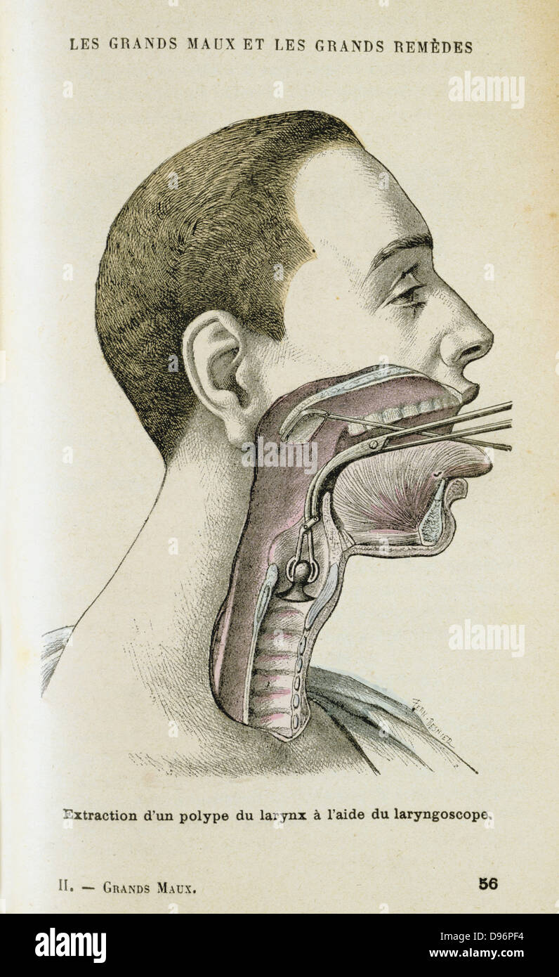 Using a laryngoscope to aid a surgeon in the removal of a polyp from the throat, c1890. A small mirror on a long metal handle was invented in 1854 by a Spanish singing teacher  Manuel Garcia (1805)- 1906) to study the vocal chords. In 1858 Ludwig Turck (1810-1868) and Johann Czermak (1828-1873) both published papers on use of the instrument, but Czermak invented a headband mirror to throw light on Laryngoscope mirror, an so on the throat. From  'Les Grands Maux et les Grands Remedes' ('The Principal Illnesses and Their Remedies'), Jules Rengade, (Paris, c1890). Stock Photo