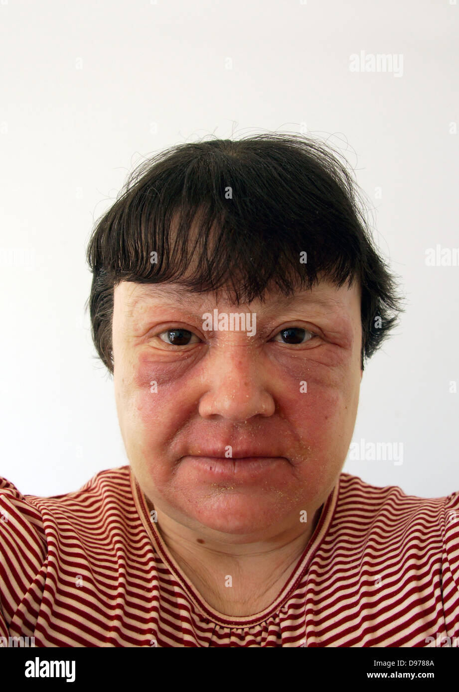 Woman suffering with eczema & a rash covering most of the face with the