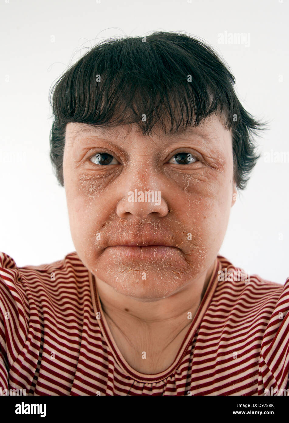 Woman suffering with eczema & a rash covering most of the face with the