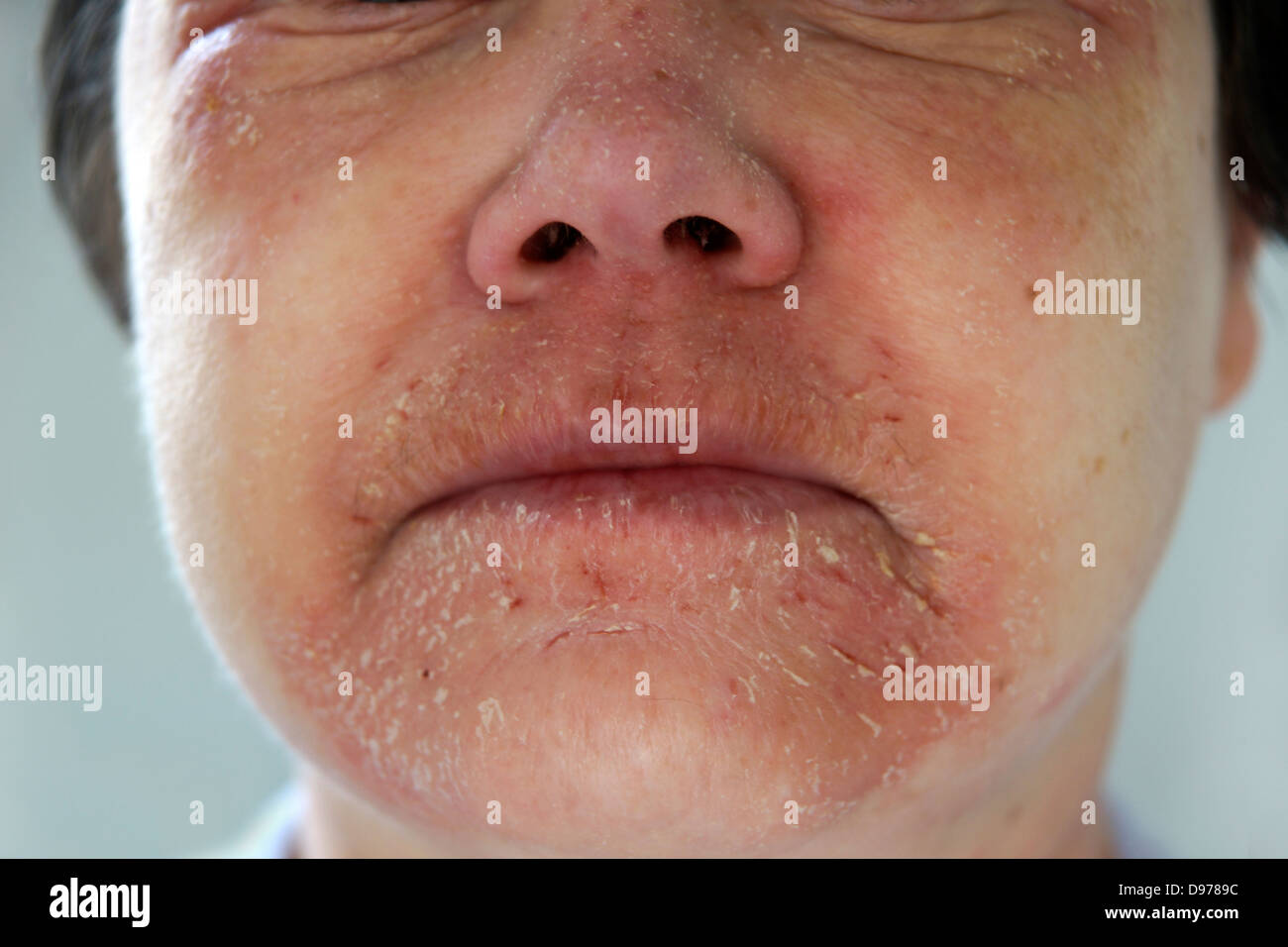 Woman suffering with eczema & a rash covering most of the face with the soreness surrounding & affecting the mouth area Stock Photo