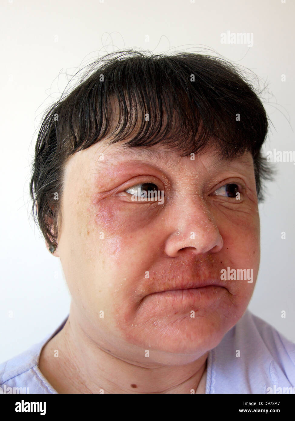 Woman suffering with eczema & a rash covering most of the face with the