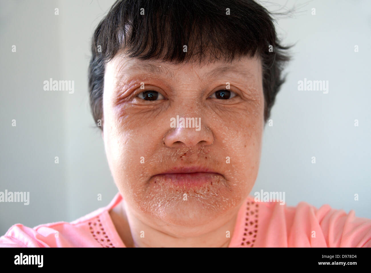 Woman suffering with eczema & a rash covering most of the face with the ...