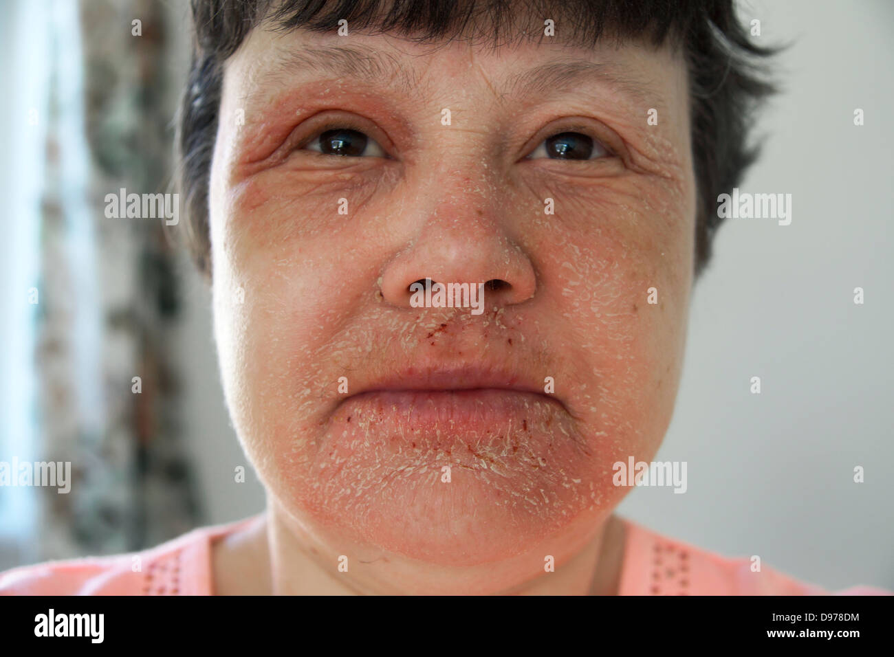 Woman suffering with eczema & a rash covering most of the face with the soreness surrounding & affecting the eyes & mouth area Stock Photo