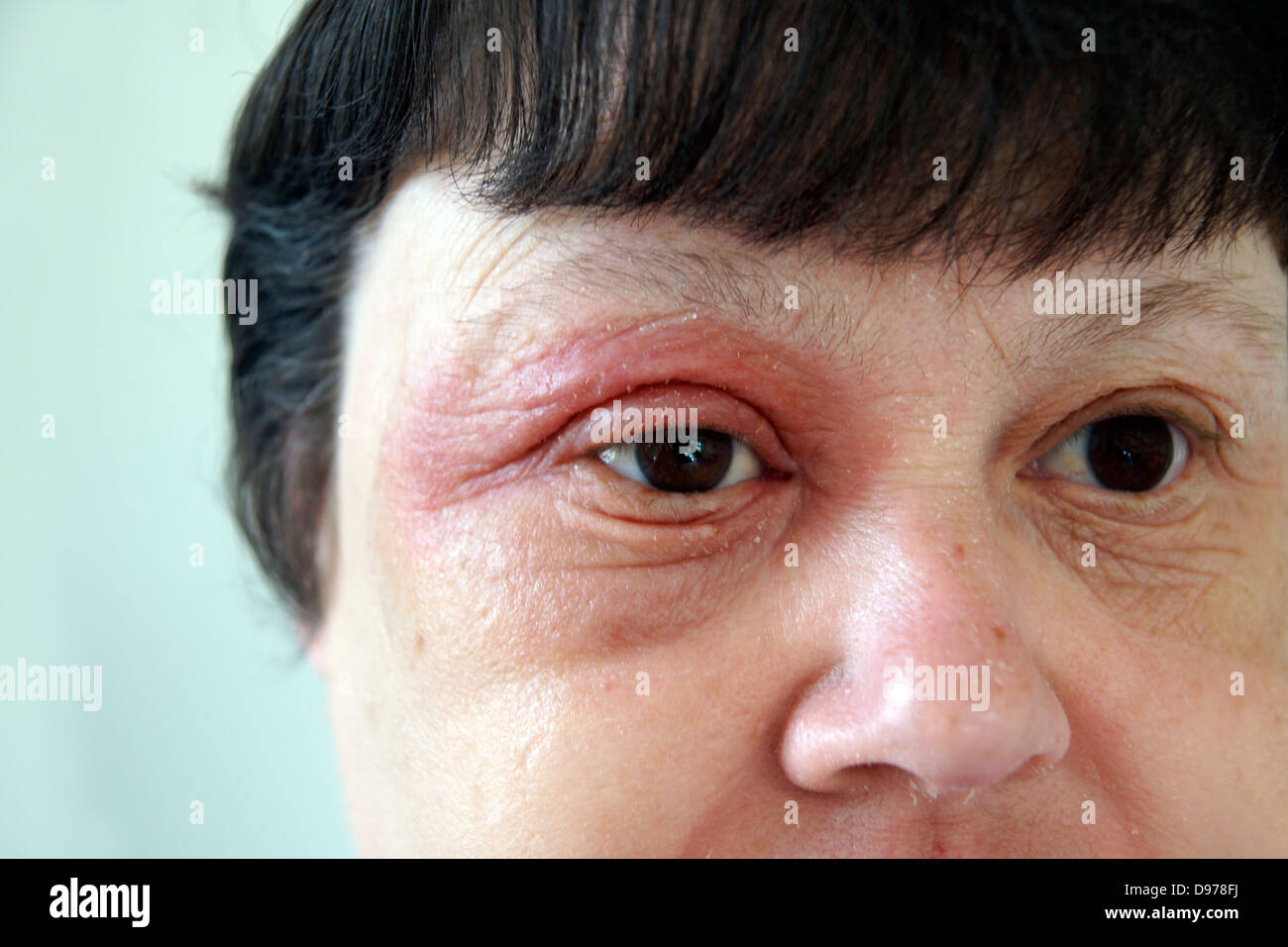 Woman suffering with eczema & a rash covering most of the face with the soreness surrounding & affecting the eyes Stock Photo