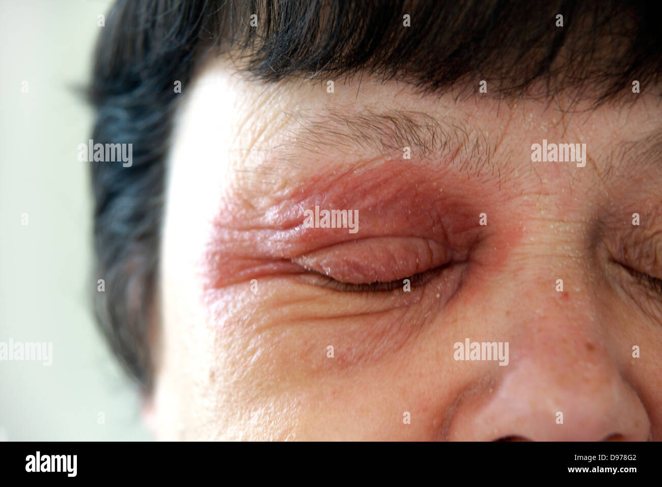 Woman suffering with eczema & a rash covering most of the face with the soreness surrounding & affecting the eyes Stock Photo