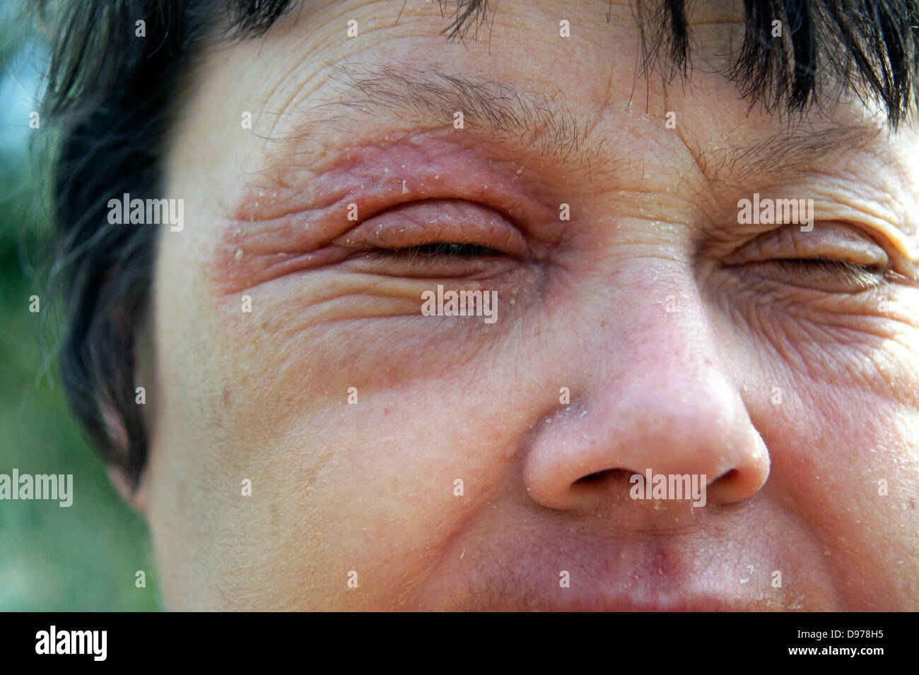 Woman suffering with eczema & a rash covering most of the face with the