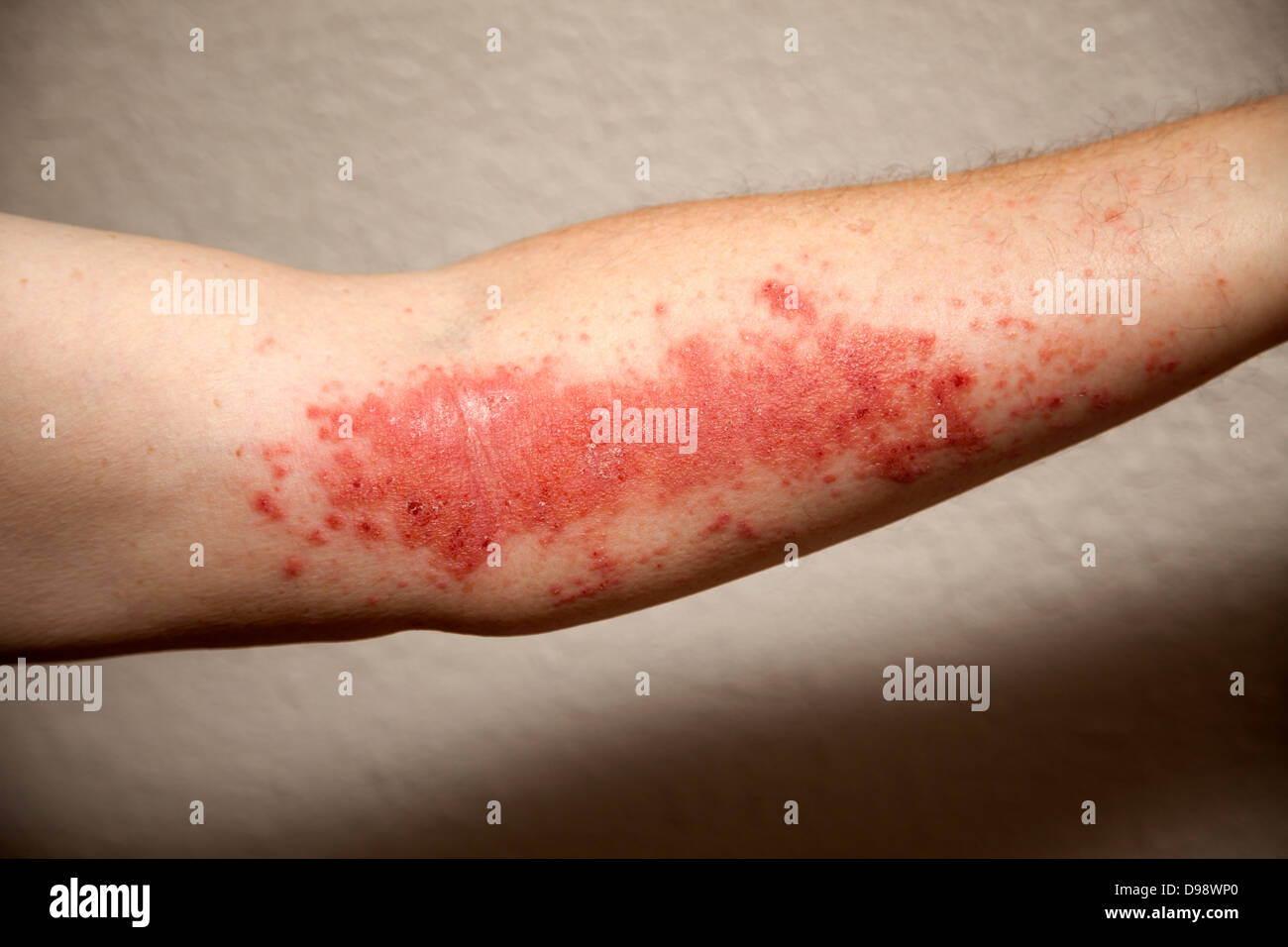 Allergic reaction to Poison Ivy Toxicodendron radicans , Eastern USA Stock Photo