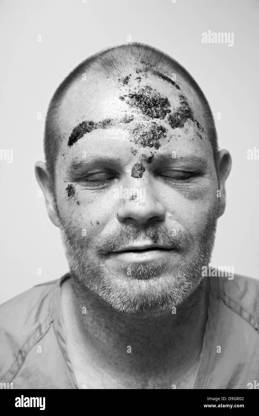 44 year old man in hospital with fractured skull. Stock Photo