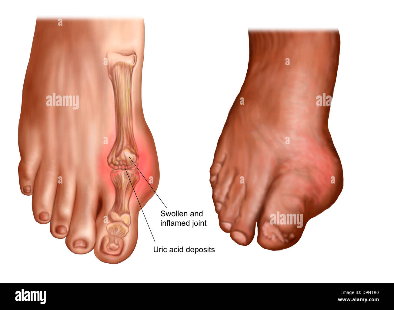 Anatomy of a swollen foot. Stock Photo