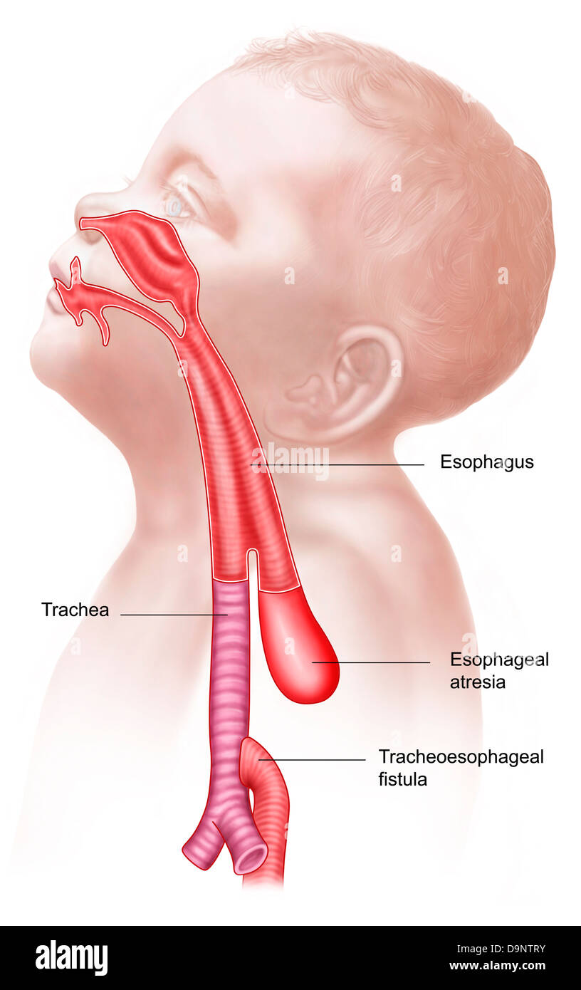 Anatomy of a tracheoesophageal fistula. Stock Photo