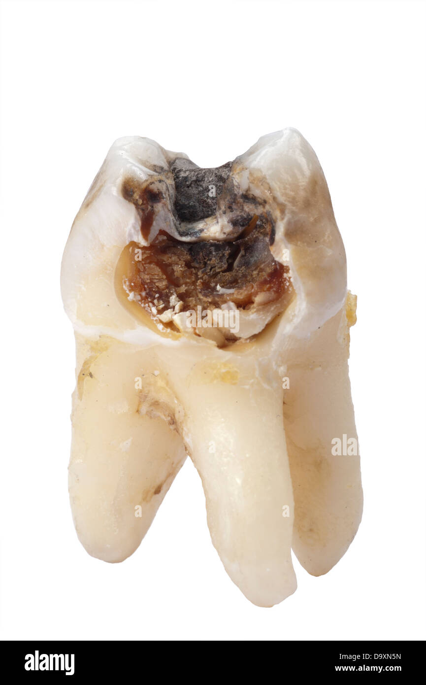 extracted tooth with cavity and caries Stock Photo