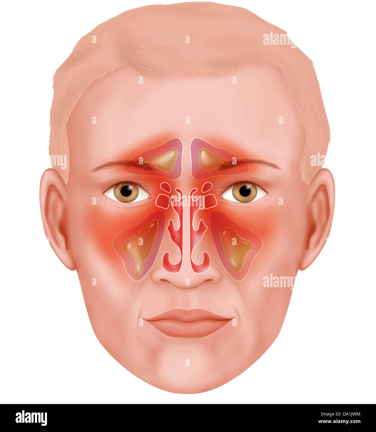 SINUSITIS, DRAWING Stock Photo