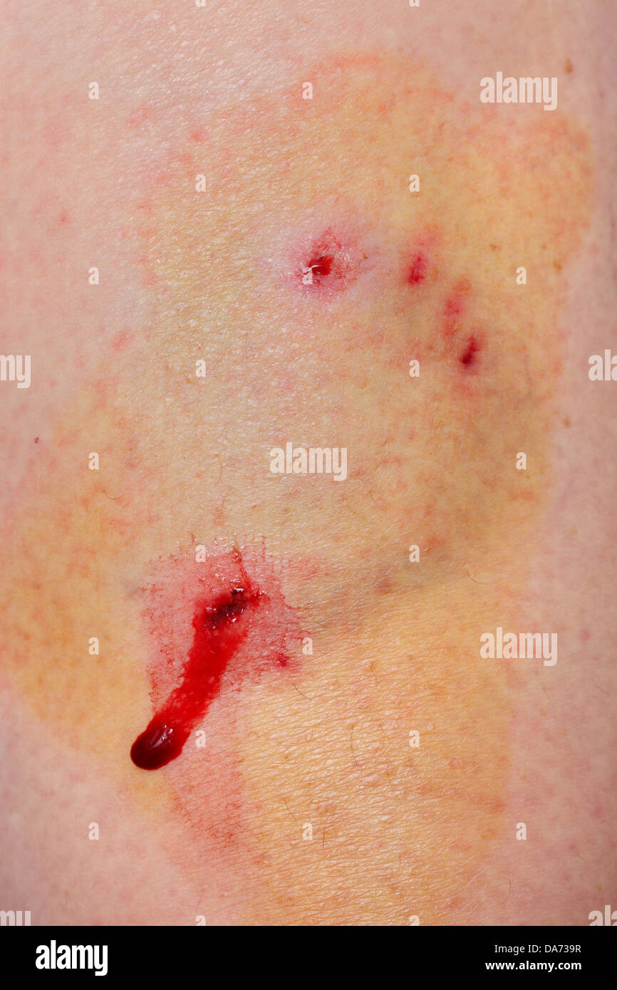 Disinfect wound hires stock photography and images Alamy