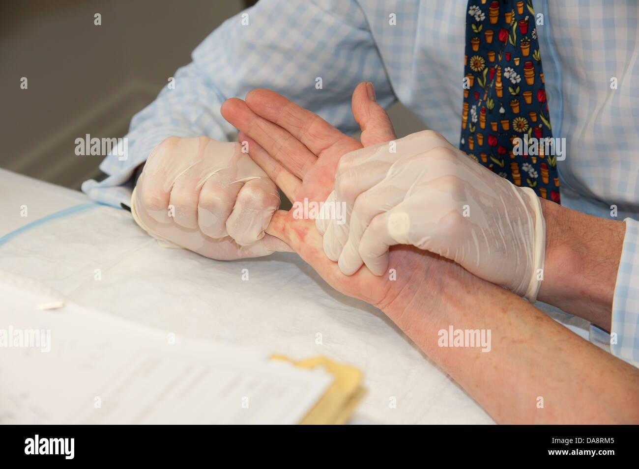 Dupuytren's contracture treatment of the little finger on a woman's hand doctor manipulating hand following procedure Stock Photo