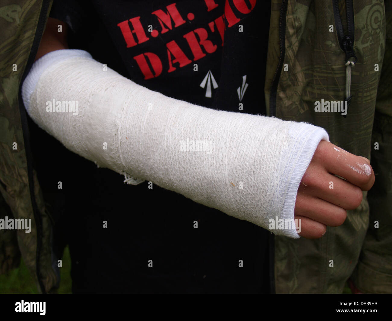 Temporary cast on a fractured wrist, UK 2013 Stock Photo Alamy