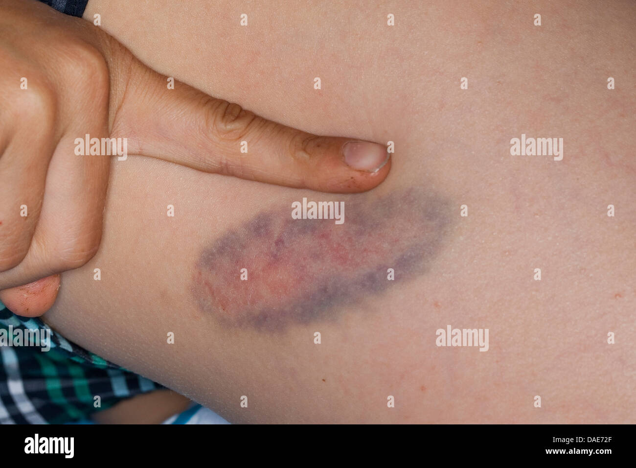 bruise at a leg, Germany Stock Photo