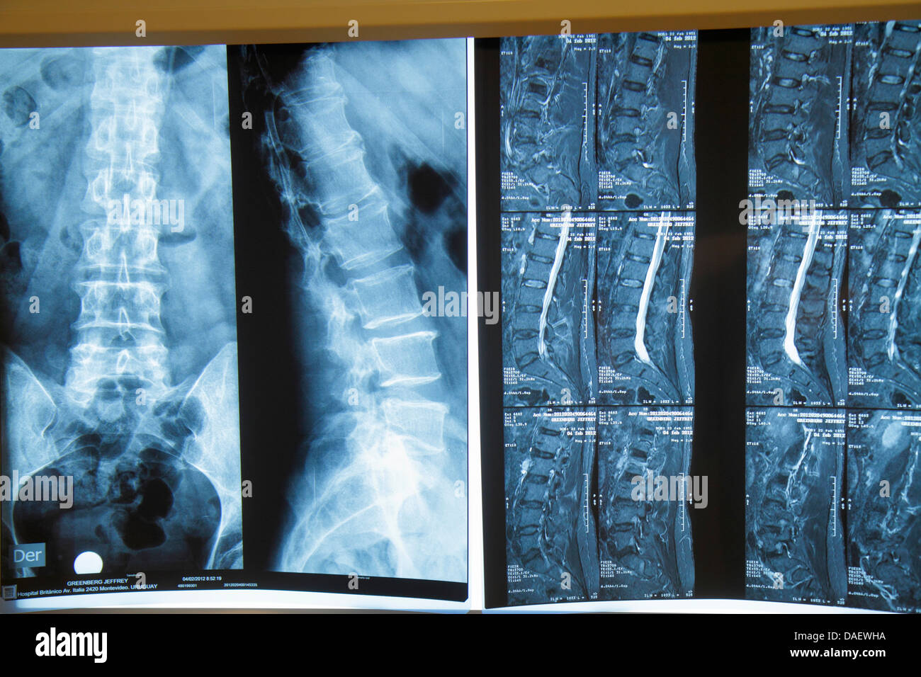 Miami Beach Florida,Mount Sinai Medical Center,centre,hospital,xray,x-ray,spinal column,slipped disc,rupture,FL130601008 Stock Photo