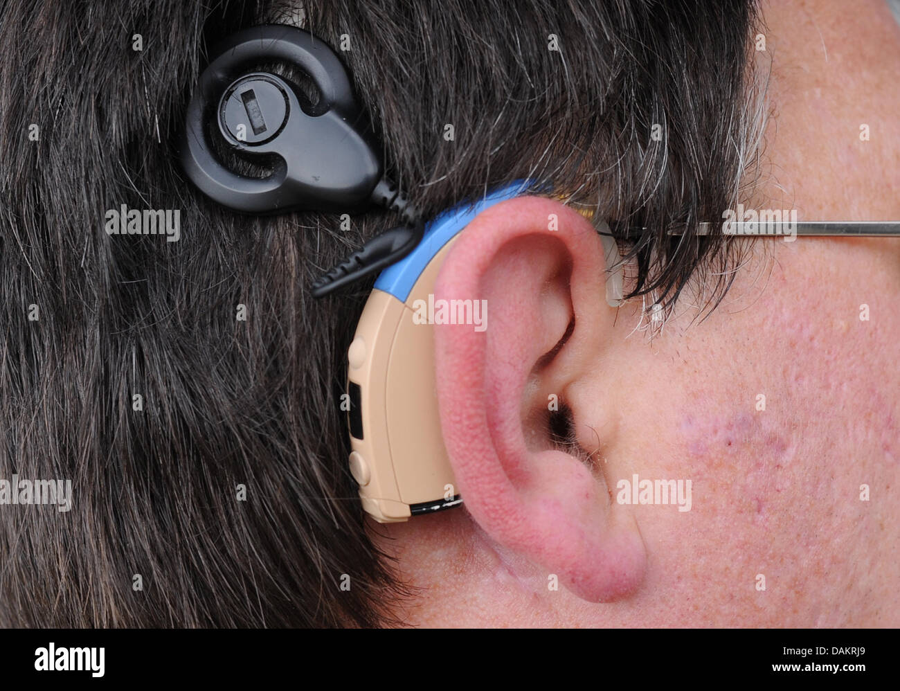 Patient Juergen Hofmann presents his new middle ear implant DACS (Direct Acoustic Cochlear Simulator) at the Hanover Medical School (MHH) in Hanover, Germany, 04 May 2011. 13 patients received the new implant since 2009. Photo: Julian Stratenschulte Stock Photo