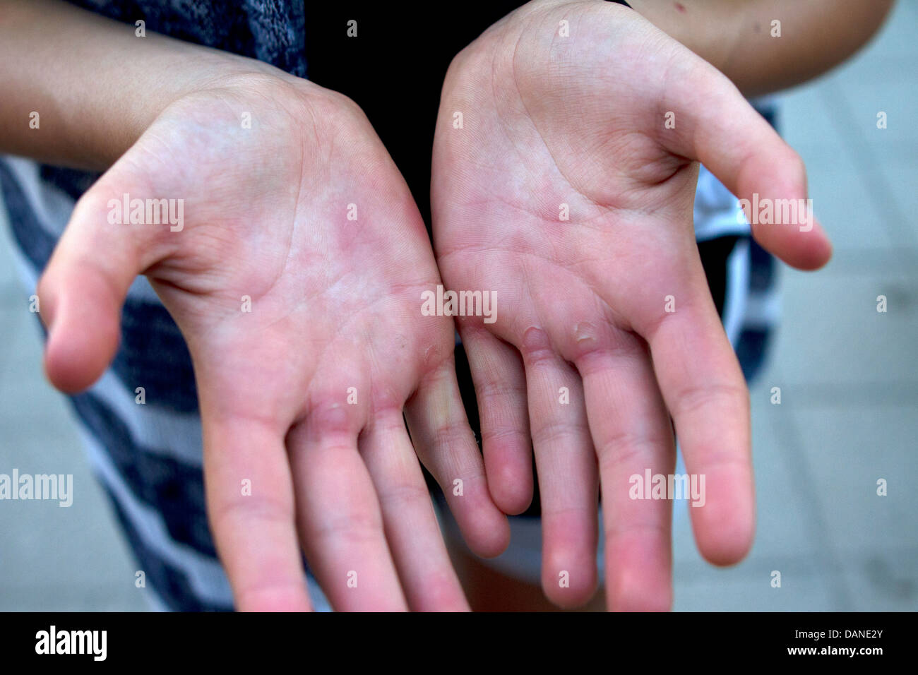 A rower shows their blistered hands Stock Photo 58249715 Alamy