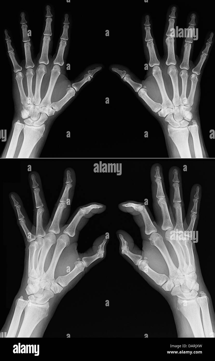 Xrays of hands of an adult man with visible damage Stock Photo Alamy