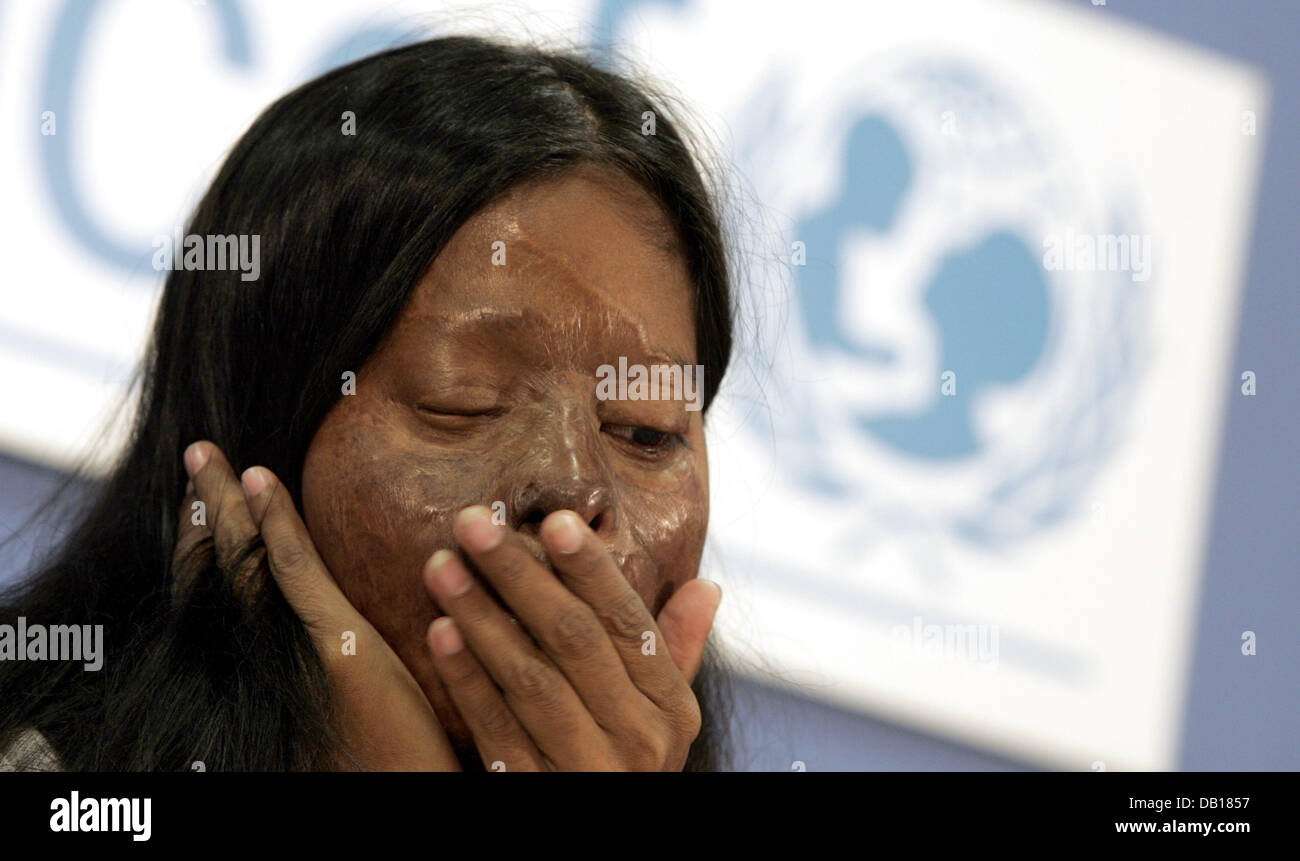 Hasina Akter from Bangladesh, who fell victim to an Acid attack at the age of 17, tells her story at a UNICEF press conference in Berlin, Germany, 16 November 2007. Millions of girls and boys around the world are still vulnerable to exploitation and violence, regardless of the UN-Convention on the Rights of the Child. Annually about 1.2 million children fall into the hands of human Stock Photo
