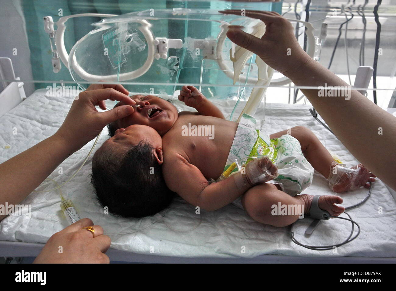 TWO HEADED BABY Conjoined female twins were born in Suining City on May 5, 2011. Two previous ultrasonic scans in September and February both revealled only a single embryo, but a final scan two days before the birth revealled that the daughter of mother Stock Photo