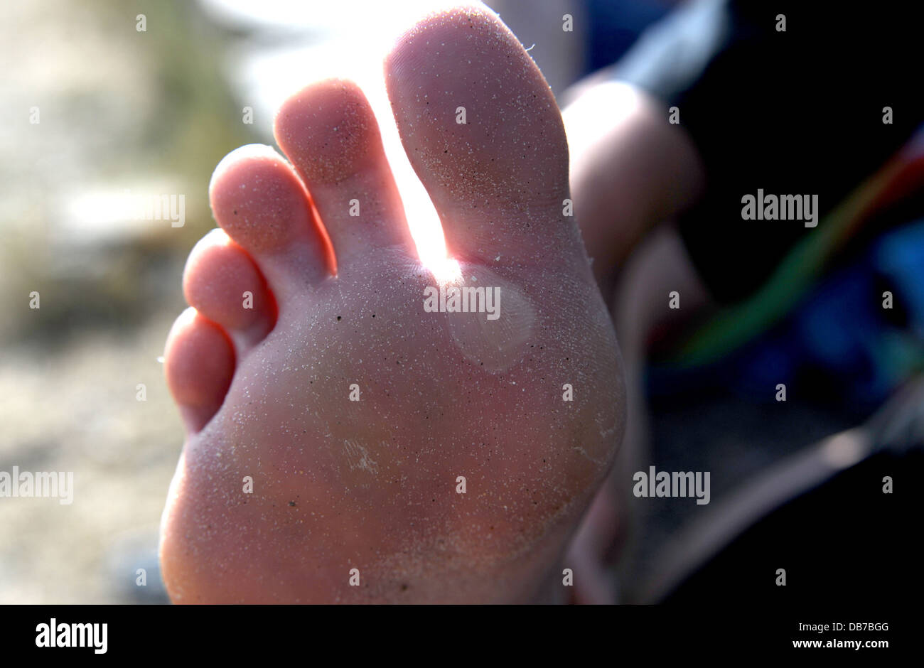 https://c8.alamy.com/comp/DB7BGG/young-woman-with-blisters-on-the-soles-or-bottoms-of-her-feet-DB7BGG.jpg
