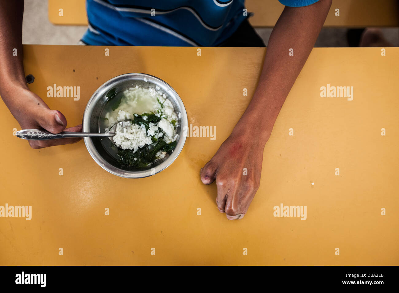 A young child with deformed hands eating in Danang, Vietnam. Stock Photo