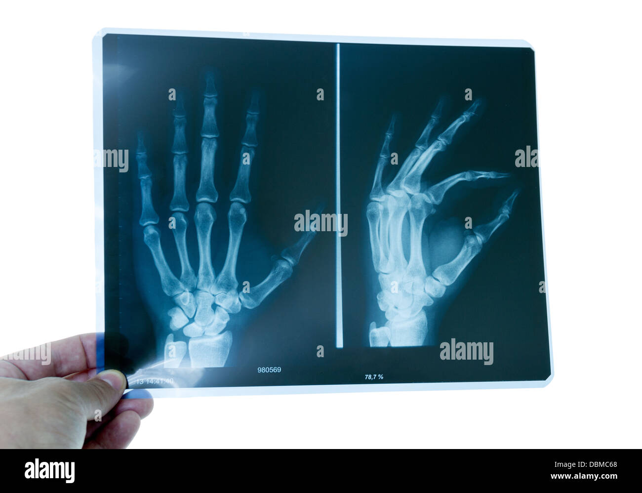 Doctor examining a hand radiography Stock Photo