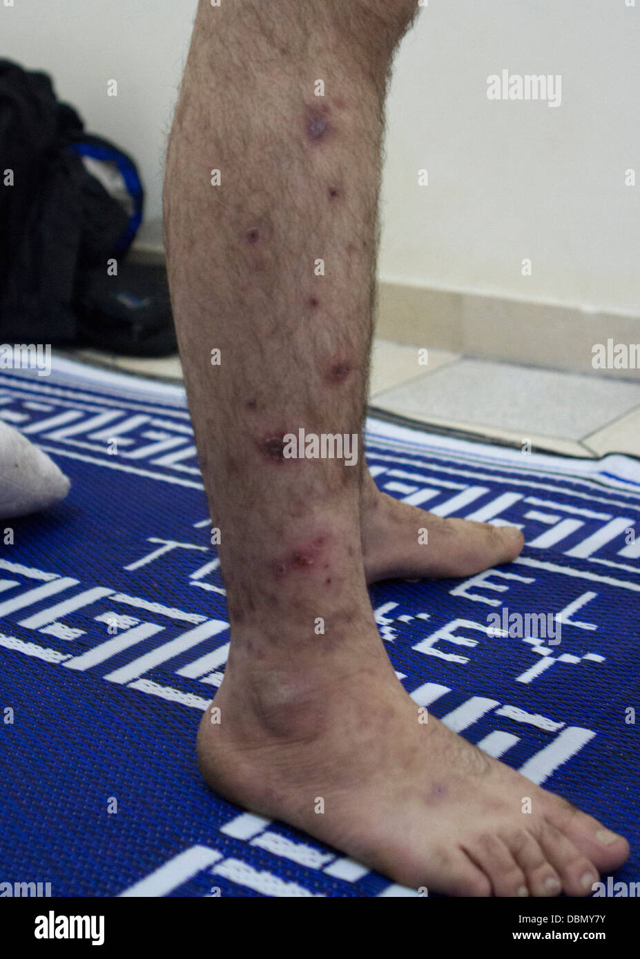 An activist shows off his scars from torture after being imprisoned at the Palestine Police Station in Damascus for three months Stock Photo