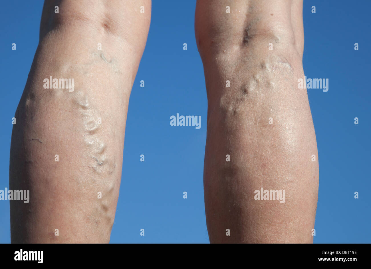 Varicose veins on back of legs of 75 year old woman UK Stock Photo