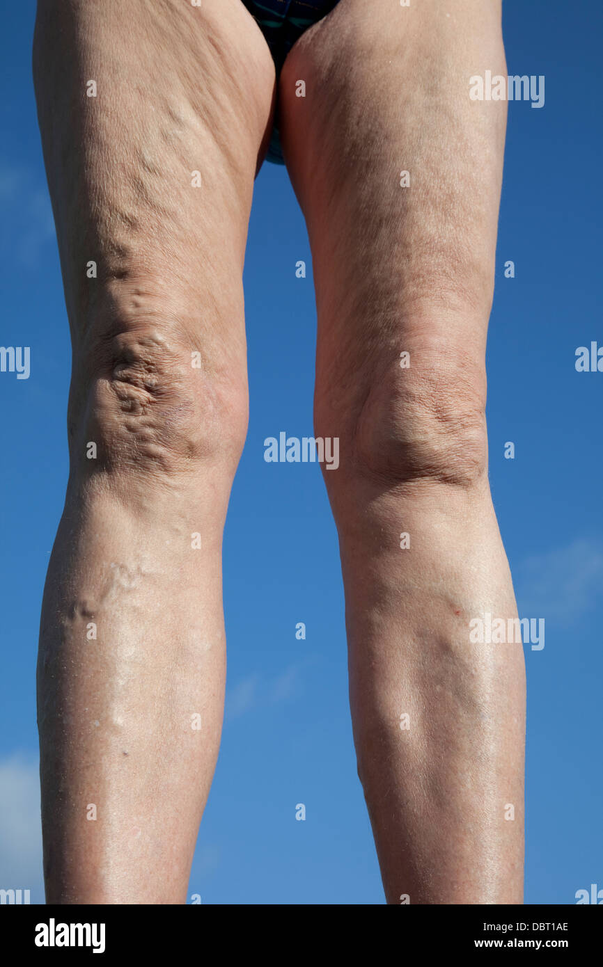 Old woman with varicose veins hi-res stock photography and images - Alamy