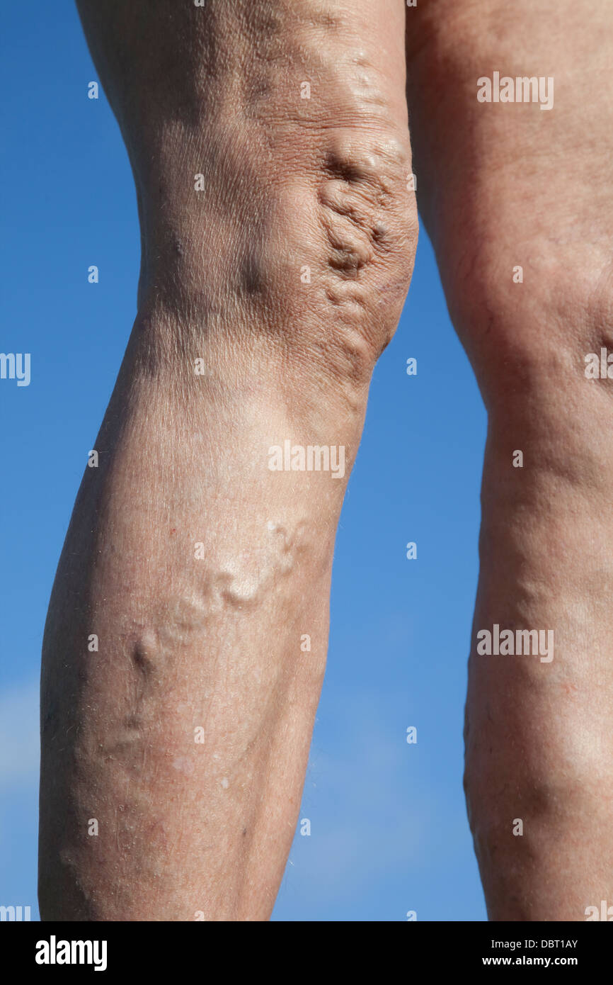 Varicose veins on legs of 75 year old woman UK Stock Photo
