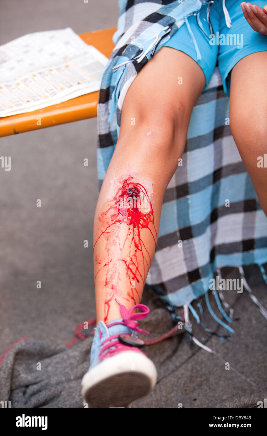 serious injury on girl's leg Stock Photo - Alamy