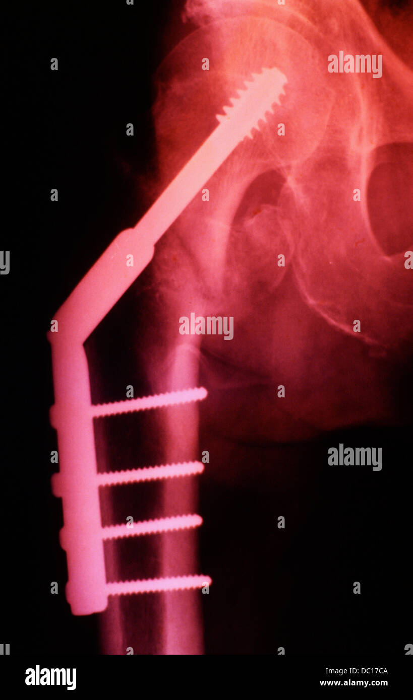 XRay of the human hip joint, showing a stainless steel dynamic hip