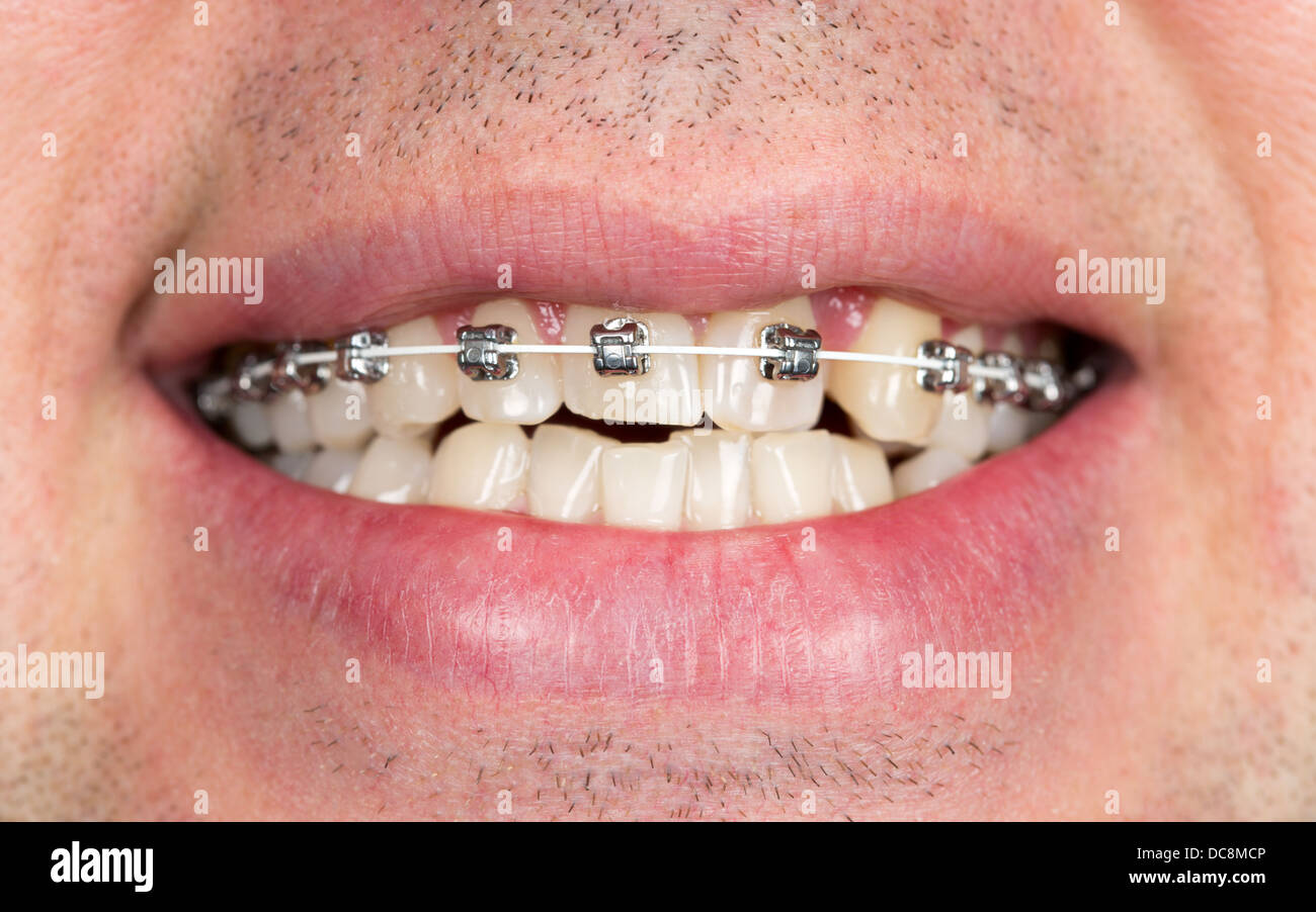 Close-up of braces on the teeth of the upper jaw with unshaven men Stock Photo